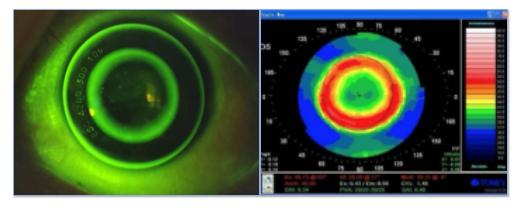 ok镜能控制眼轴增长吗,戴ok镜眼轴会不增长吗