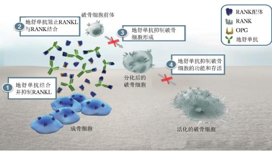 地舒单抗抗骨质疏松的机制,地舒单抗治疗骨质疏松骨折