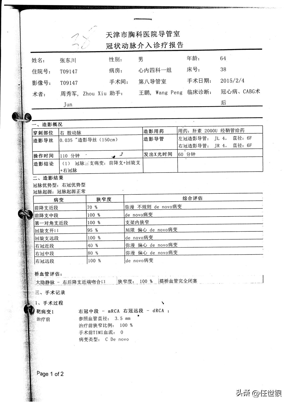 重症冠心病的新法治疗系列病例报导之四