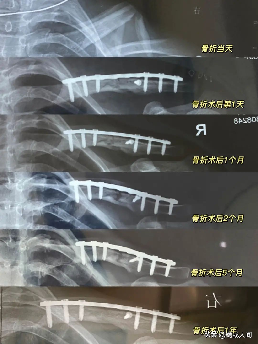 髋臼粉碎性骨折术后多久能下地,粉碎性骨折一年了还没有完全愈合