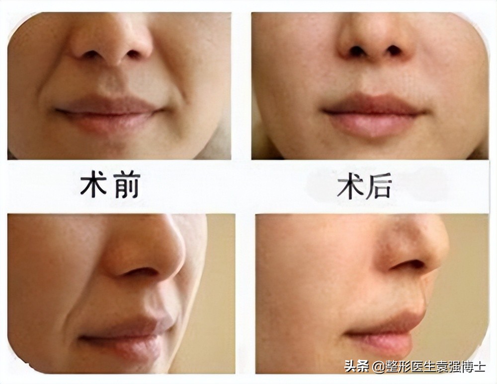 40岁女人脸要怎么保养去法令纹,40岁男士法令纹最新消除法