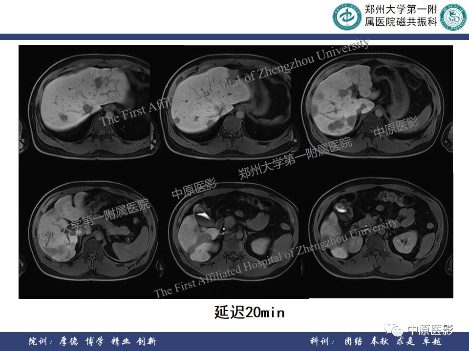 肝脏血管瘤样本,正确认识肝脏血管瘤文章