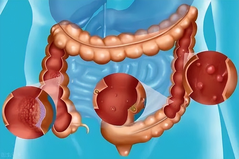 新龙甘消炎膏对痔术后疼痛及水肿的相关效性随机对照临床试验