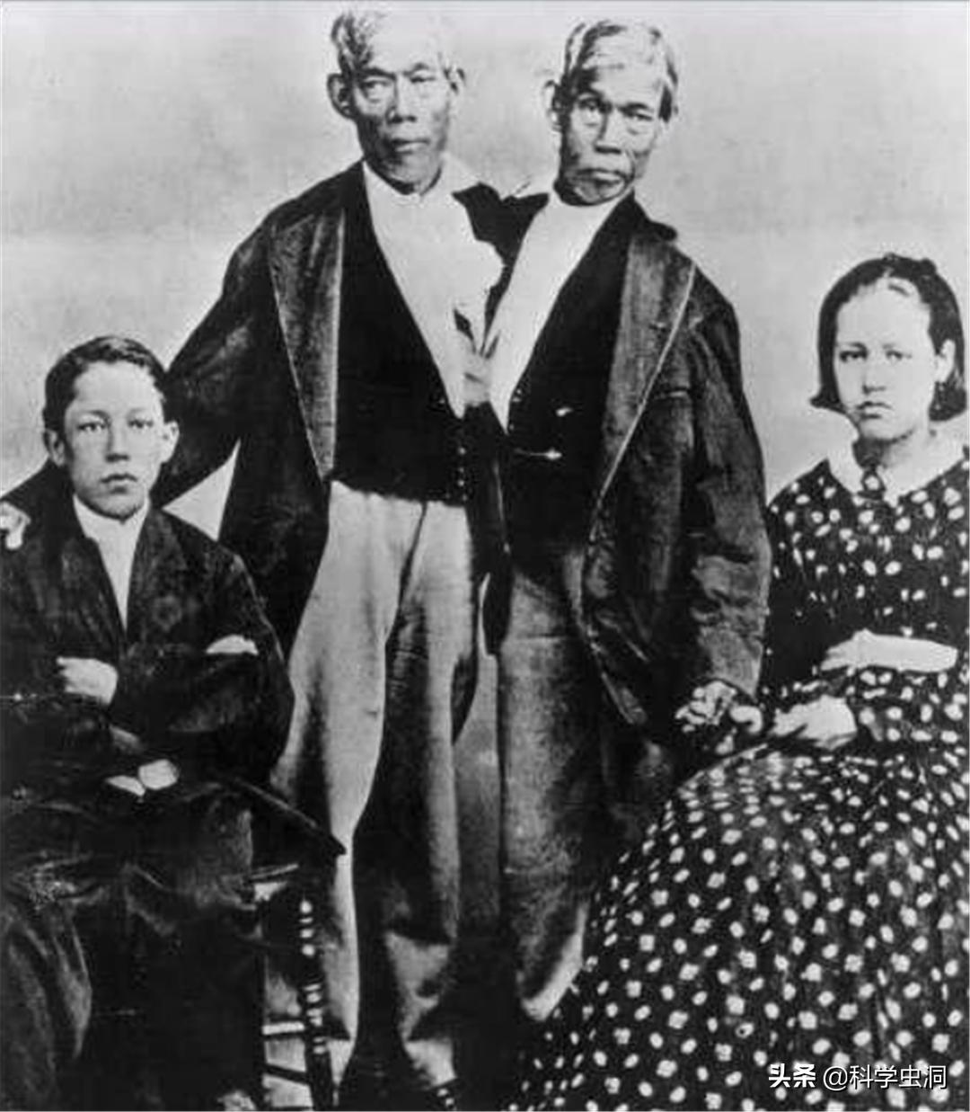 连体姐妹其中一个人死了怎么办,连体姐妹一个死了另一个咋办