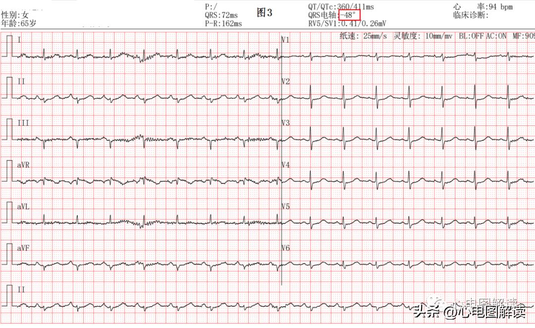 心电图会误诊冠心病吗,心电图会误诊心肌梗死吗