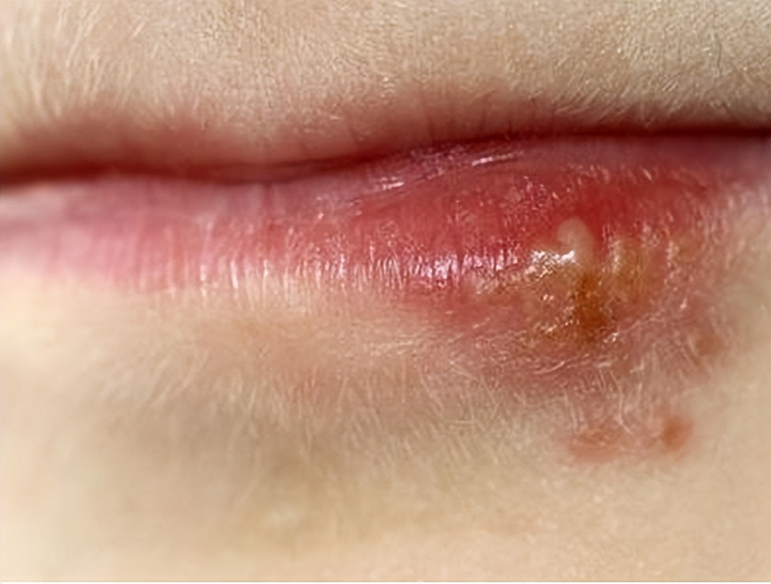 嘴上出了好多透明水泡会传染吗,嘴上上火长水泡会传染吗