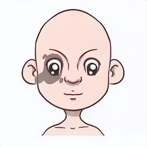 新生儿有胎记怎么办,新生儿有胎记是怎么造成的