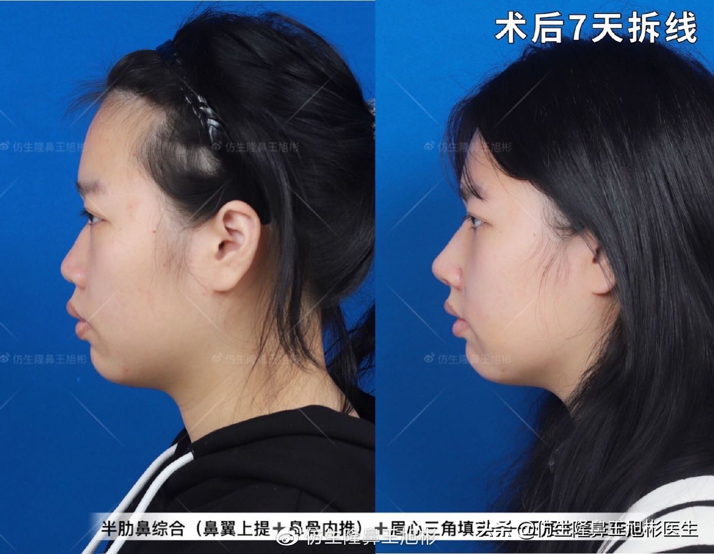 常见鼻部整形美容项目,整形鼻和自然鼻