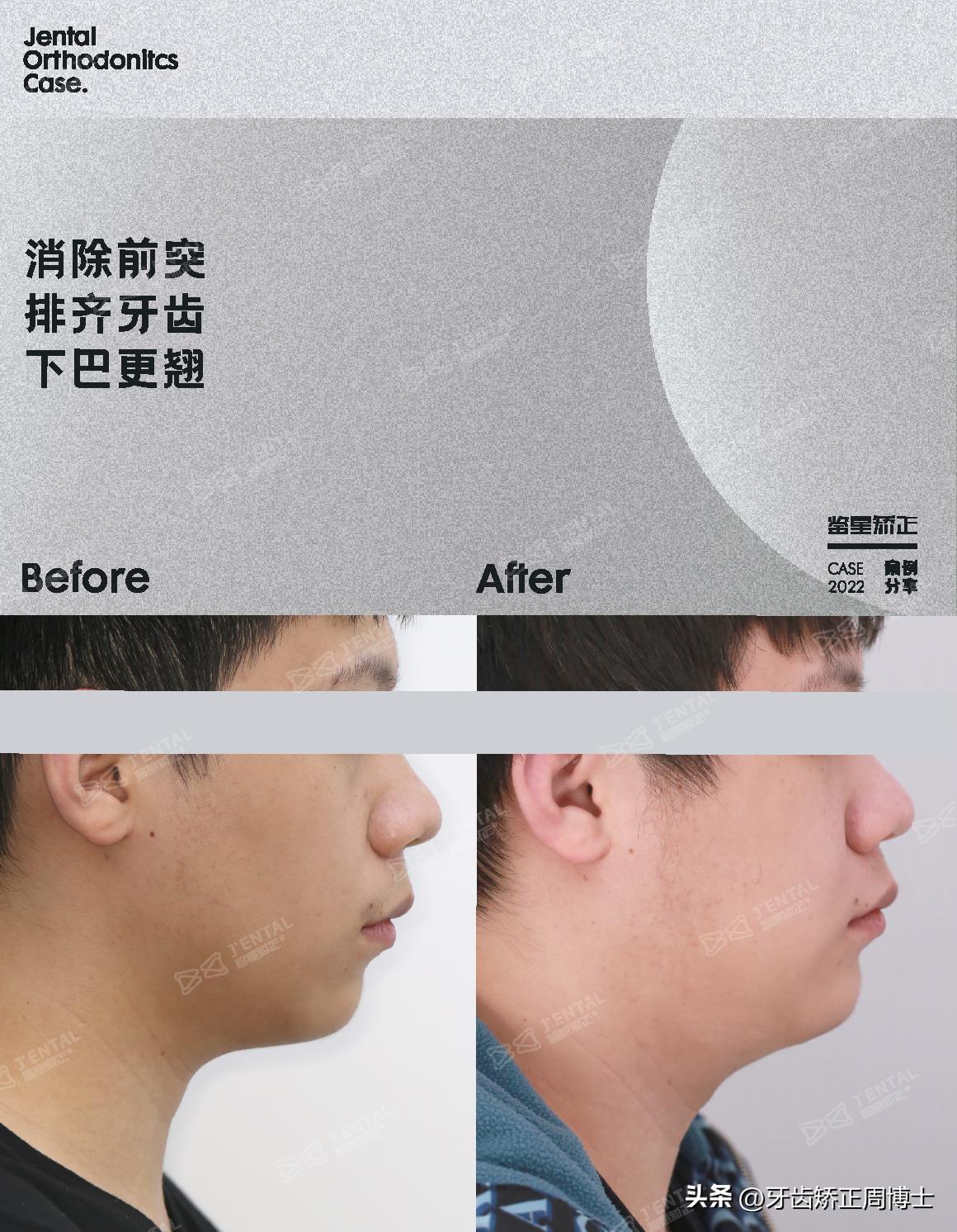 小孩牙齿为什么迟迟不长,孩子牙齿刚长出来不齐怎么办