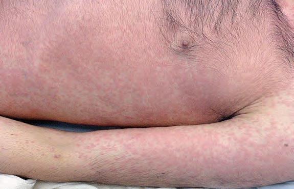 药物反应引起皮肤瘙痒,吃药后皮肤出现药疹