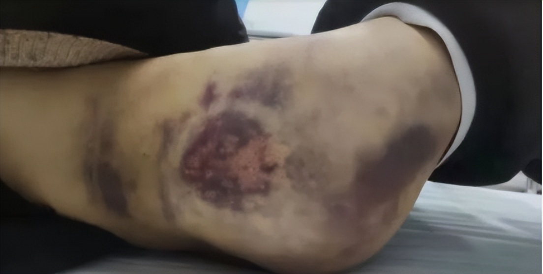 麦瑞克9度smart筋膜枪缺点,筋膜枪是否真的有效