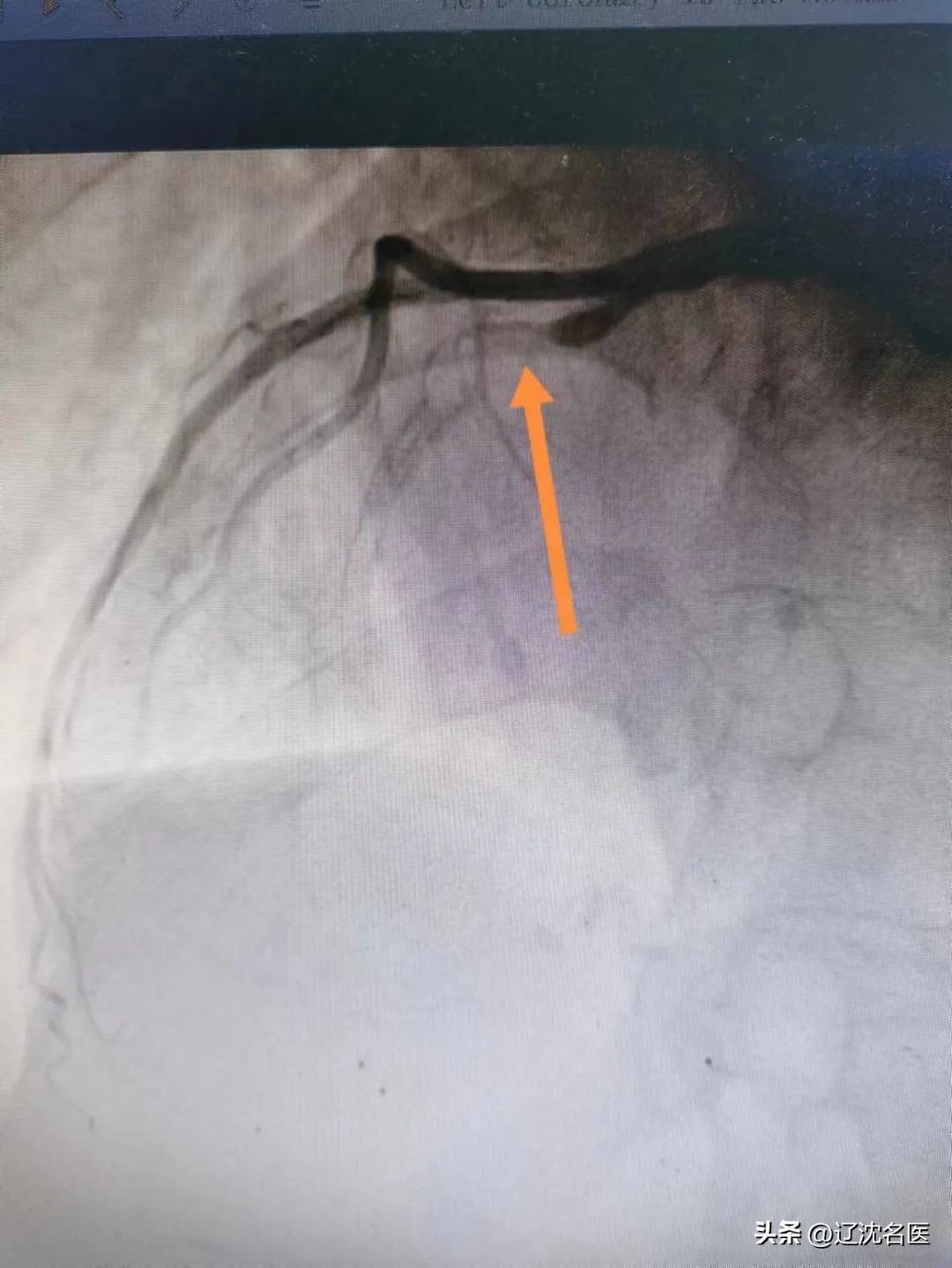 心脏长在右边，突发心梗咋救？！沈阳十院心脏中心救援纪实
