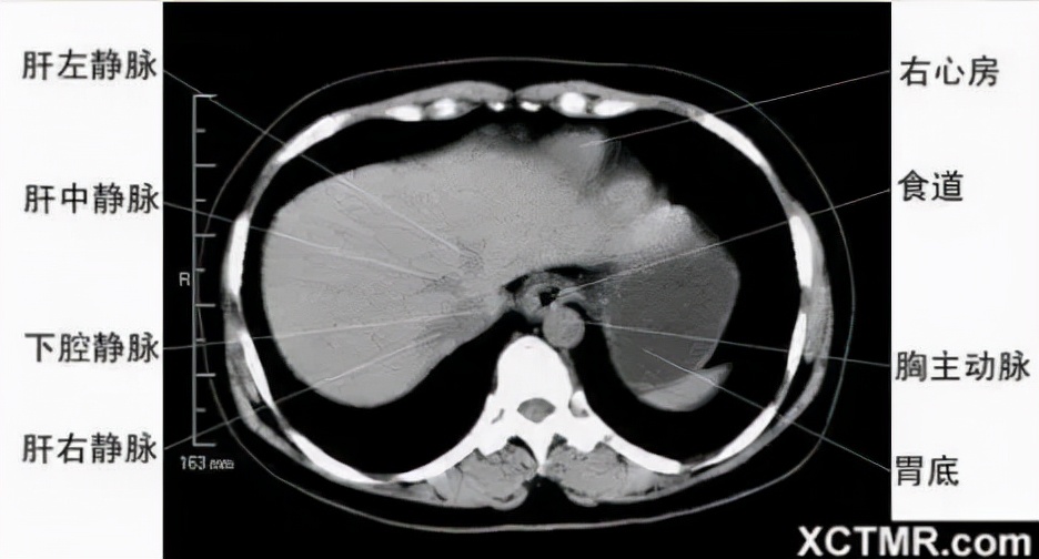 胸腹部盆腔ct主要检查什么,女性盆腔ct断层解剖结构图