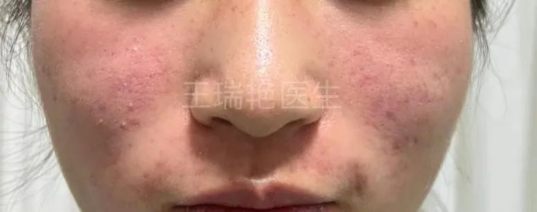 男生吃异维a酸有副作用吗,童诺异维a酸红霉素副作用