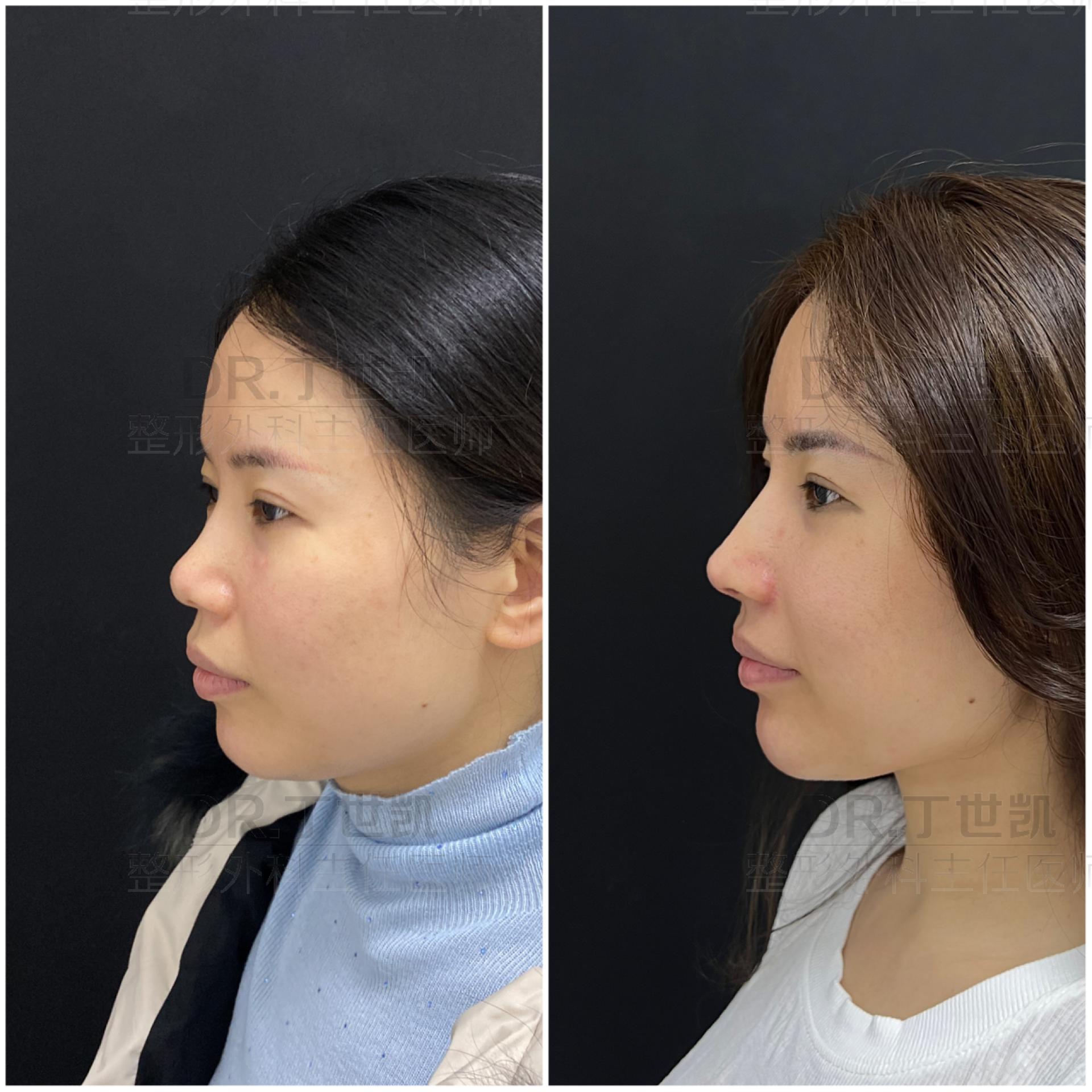 隆鼻三个月鼻子发红不痛不痒,隆鼻发炎鼻尖发红吃什么药