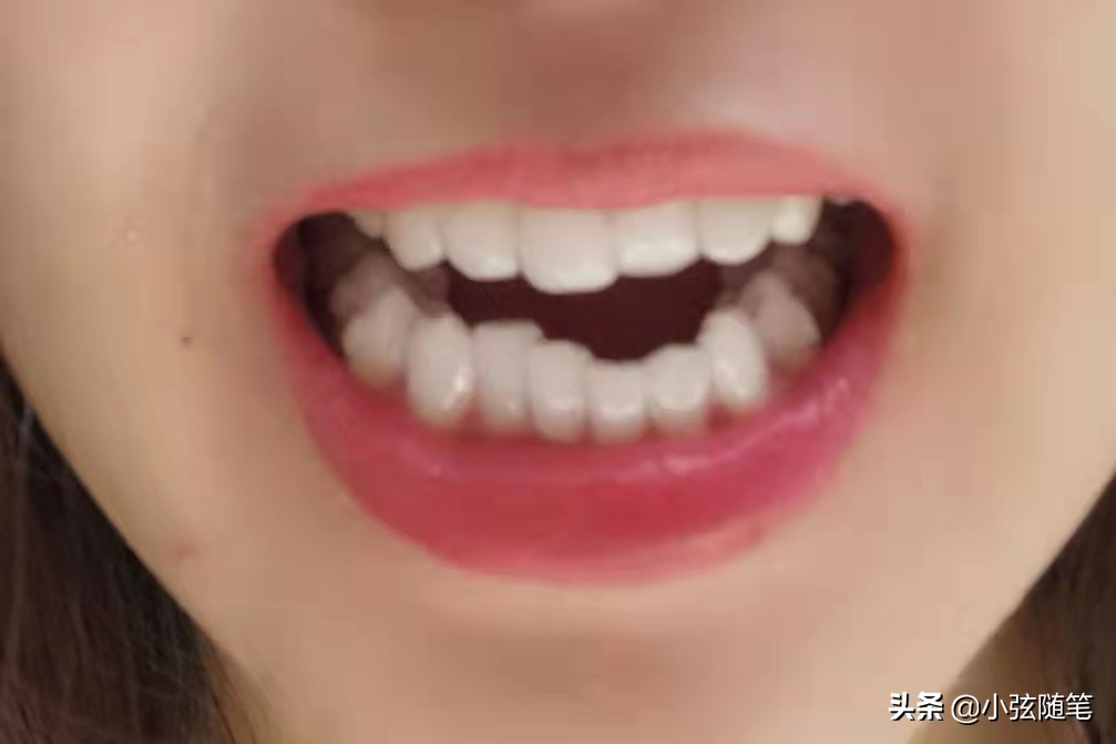 隐形矫正牙齿一万多,牙齿矫正和隐形牙齿矫正的全过程