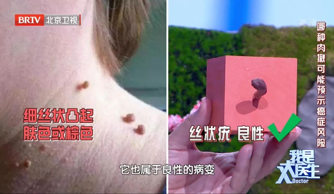 身上的小疙瘩咋治疗,皮肤出现小疙瘩一抠一个小洞