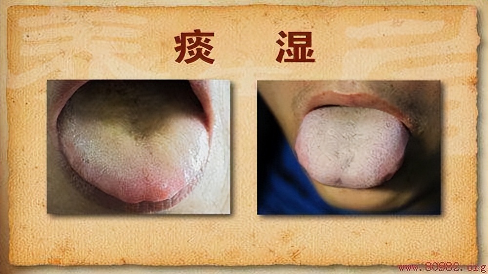 舌下有青筋就是有血瘀吗,舌下青筋是血瘀体质的症状