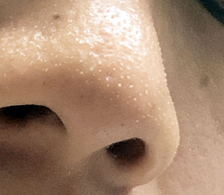 超微小气泡美容有用吗,美容院小气泡