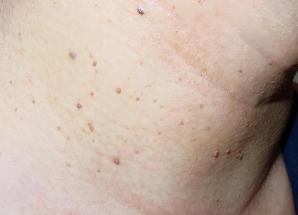 脖子上的小肉粒揪下去会变多吗,脖子腋下长小肉粒可以用手揪掉吗