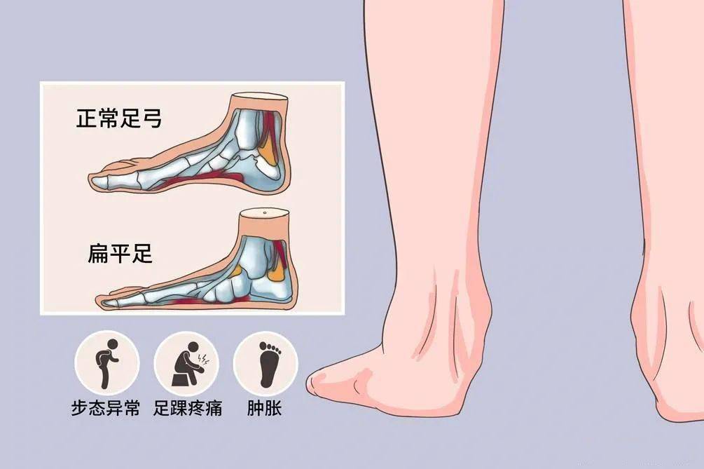 扁平足穿鞋子有什么讲究吗,扁平足要穿专用的鞋子吗