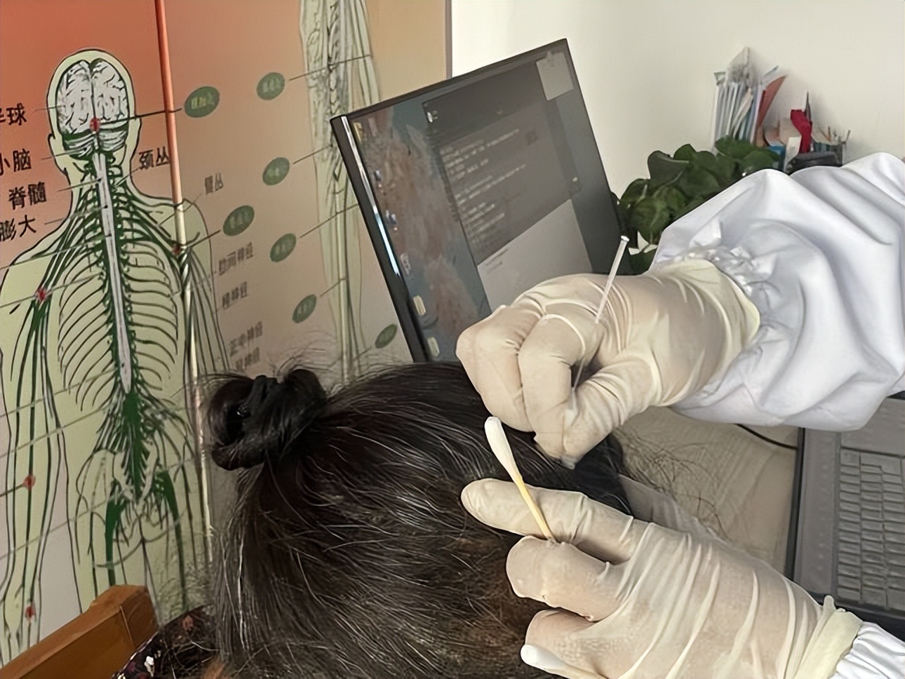 非遗针灸特色疗法,思茅针灸