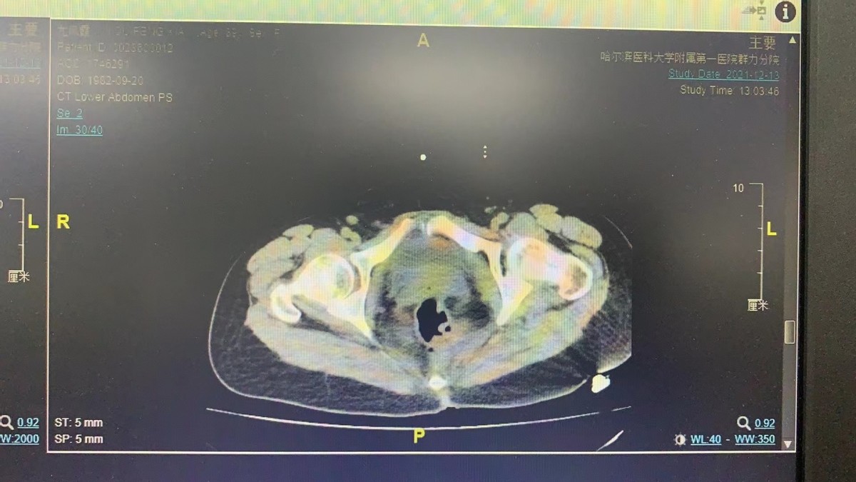 哈医大一院妇科一病房,哈医大一院群力妇科