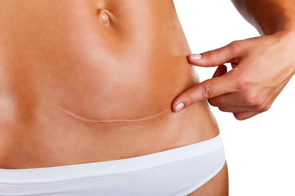 剖腹产切断了哪些经脉,剖腹产经络割断了能恢复吗