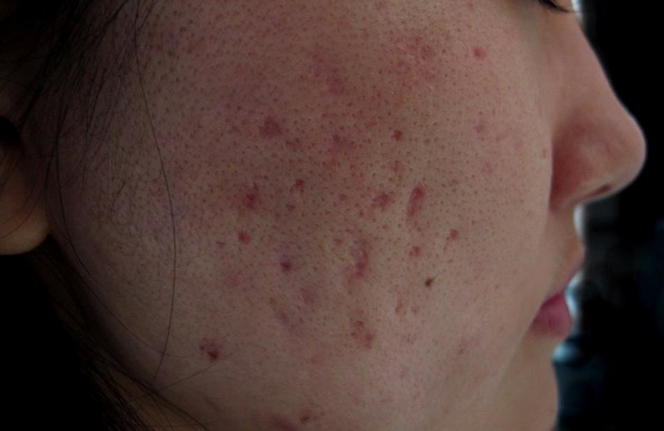 脸上有痘痘用日常方法解决,脸上长了一个痘痘的正确处理方法