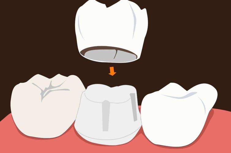 做了根管治疗感觉牙齿没有咬合力,做了根管治疗的牙没有补怎么办