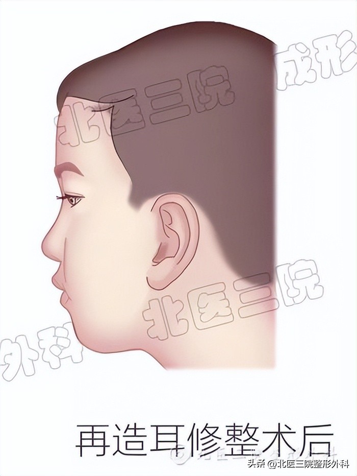 耳廓再造的三个方法,双侧无优势会影响移植吗