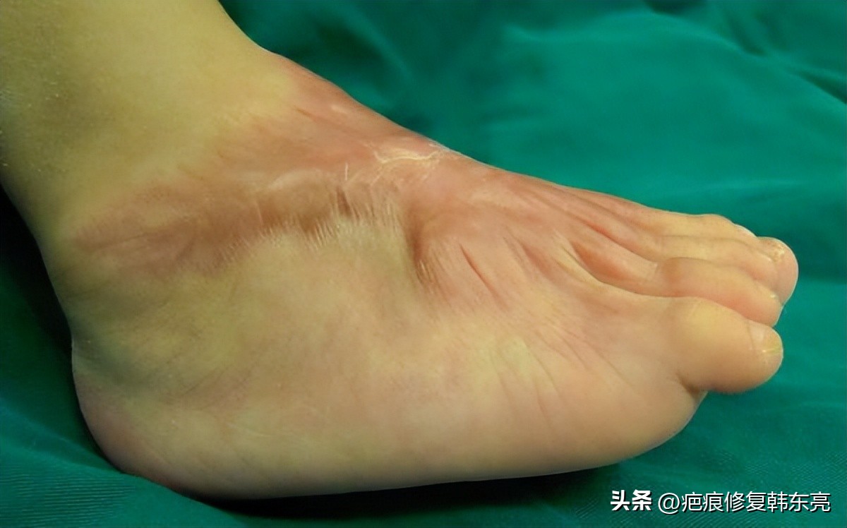 疤痕封闭治疗危害,关节处疤痕治疗