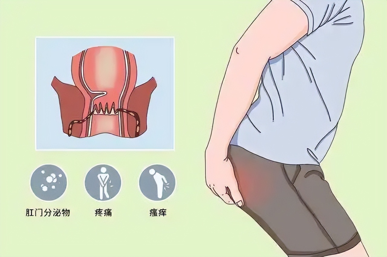 中医治疗肛瘘动画演示,肛瘘在中医上是湿热吗