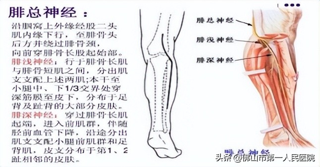 腓总神经损伤治愈技术,腓总神经损伤足下垂功能重建手术