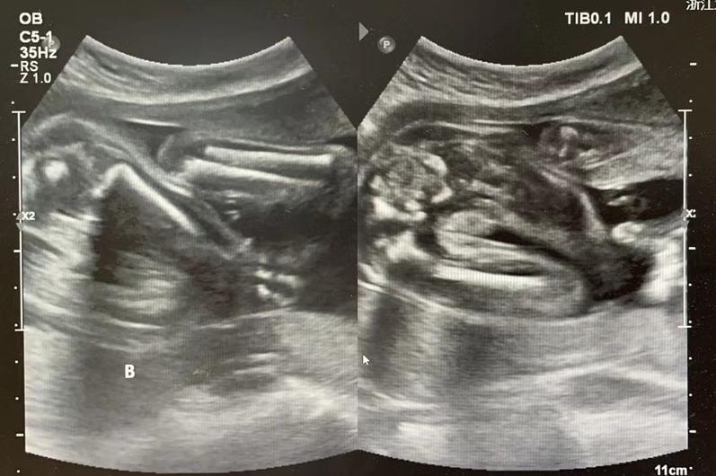 双胞胎娩出时间差,双胞胎生出来体重差多少正常