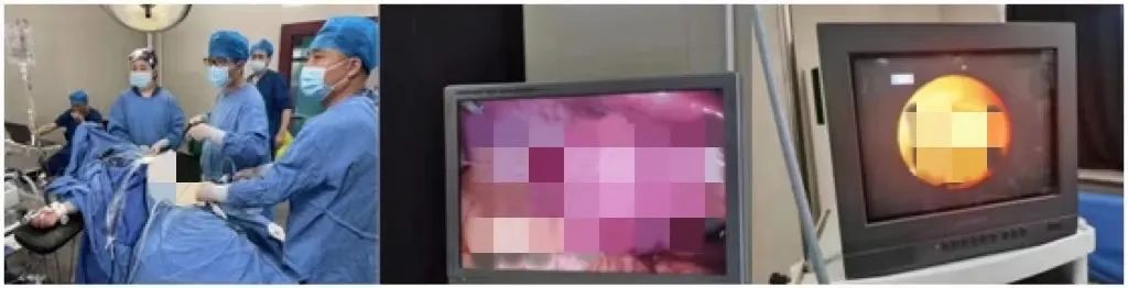 超声引导下胆囊穿刺术操作经过,超声引导下胆囊穿刺引流术动画