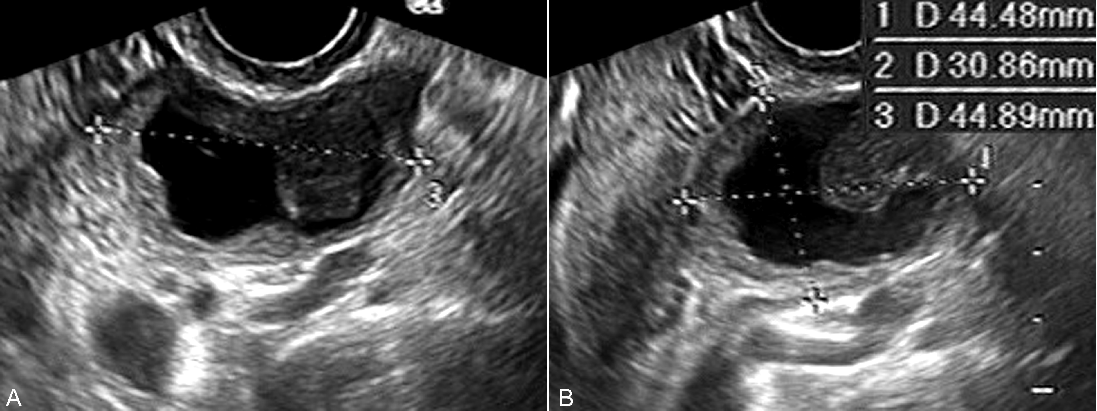 妊娠合并卵巢肿瘤指南,妊娠合并卵巢肿瘤严重吗