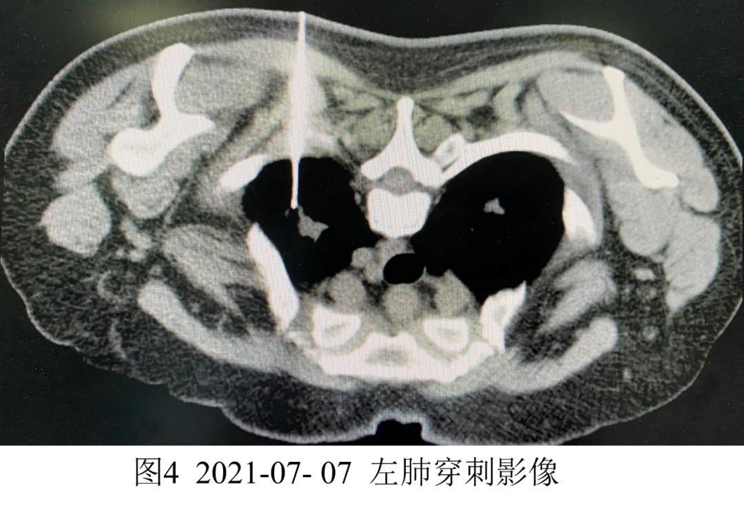 妇女双肺多发结节，病理示炎症，病情持续进展如何揭疑？