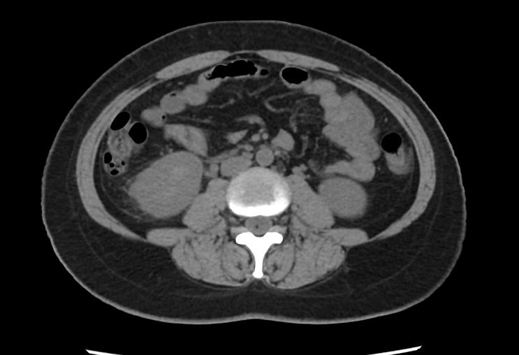 尿路感染引起的肾盂肾炎高热,急性肾盂肾炎反复高烧能吃快克吗