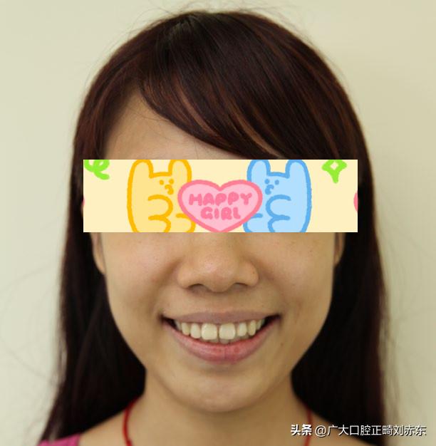 嘴凸要做正畸还是正颌,嘴凸下巴后缩应该正畸还是正颌