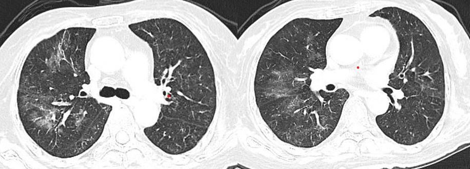 如何解读mNGS阴性结果？何时可能出现假阴性？真阴性又是为何？