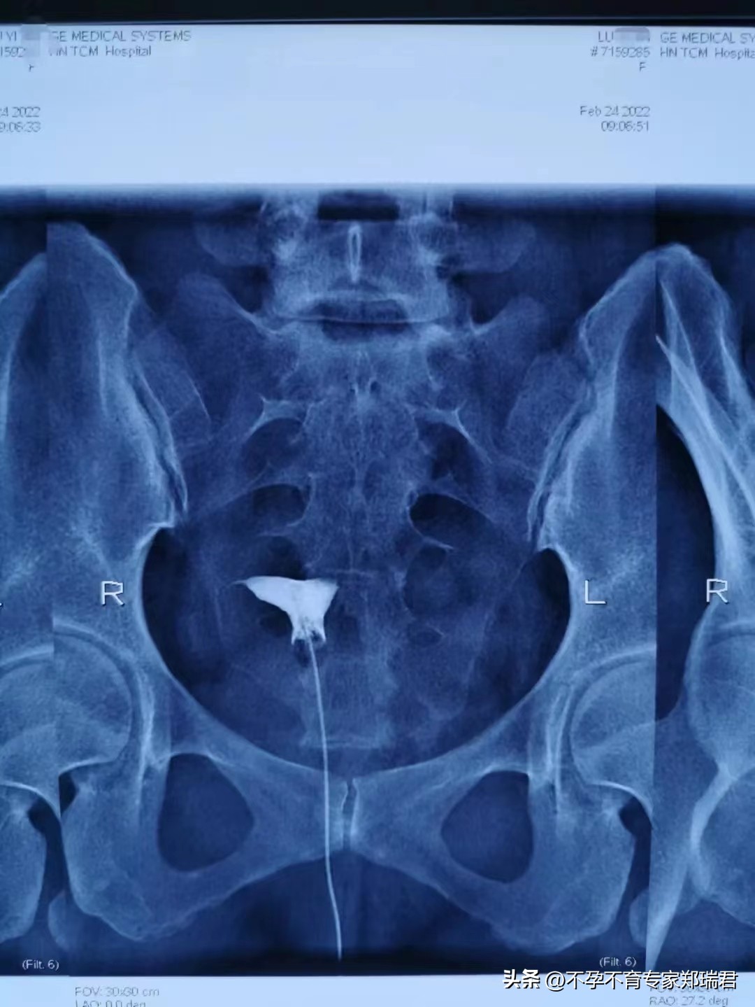 输卵管不通，成功治愈并怀孕