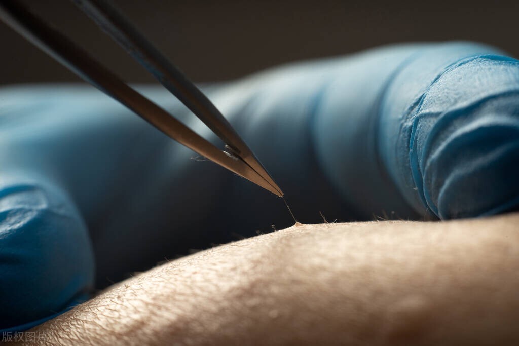 隐私部位的毛发变白,意味着体内有疾病吗?能不能刮掉?