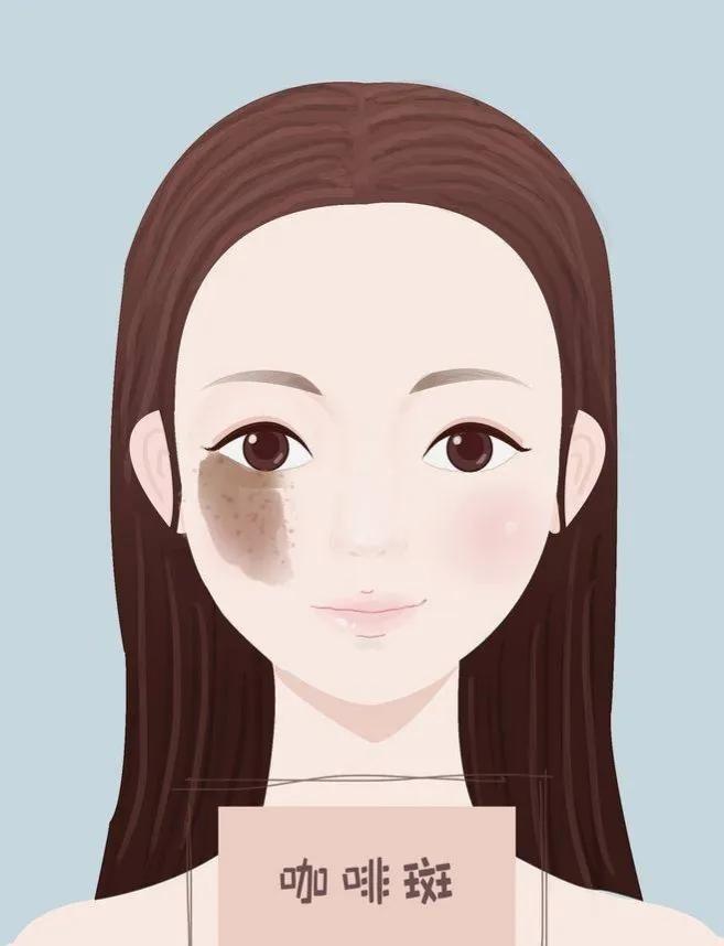 30岁脸上长斑怎么办需要注意什么,产后脸上有斑怎么办需要注意什么