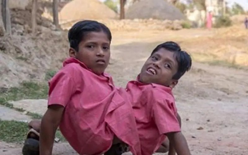 连体人是怎么诞生的,为什么会有雌雄连体人