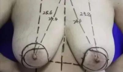 乳腺增生跟有没有男朋友有关系吗,男生乳腺增生可以通过锻炼治愈吗