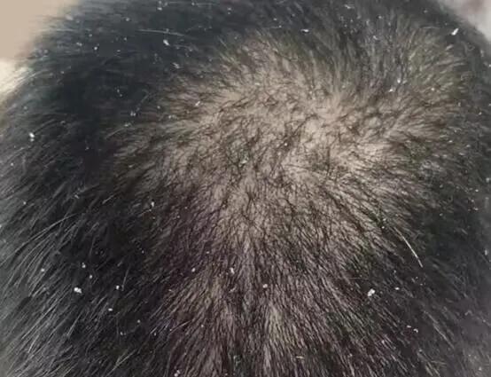 头皮屑多洗头的正确方法,头皮屑怎么处理用什么洗头最佳