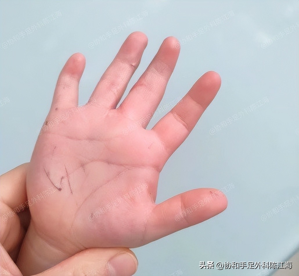 小孩多指并指免植皮新技术,儿童并指零植皮新方法