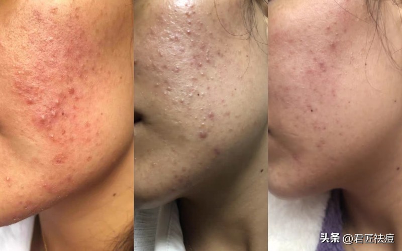 鼻子长痘痘怎么办最有效,鼻子上长痘痘的最好解决方法