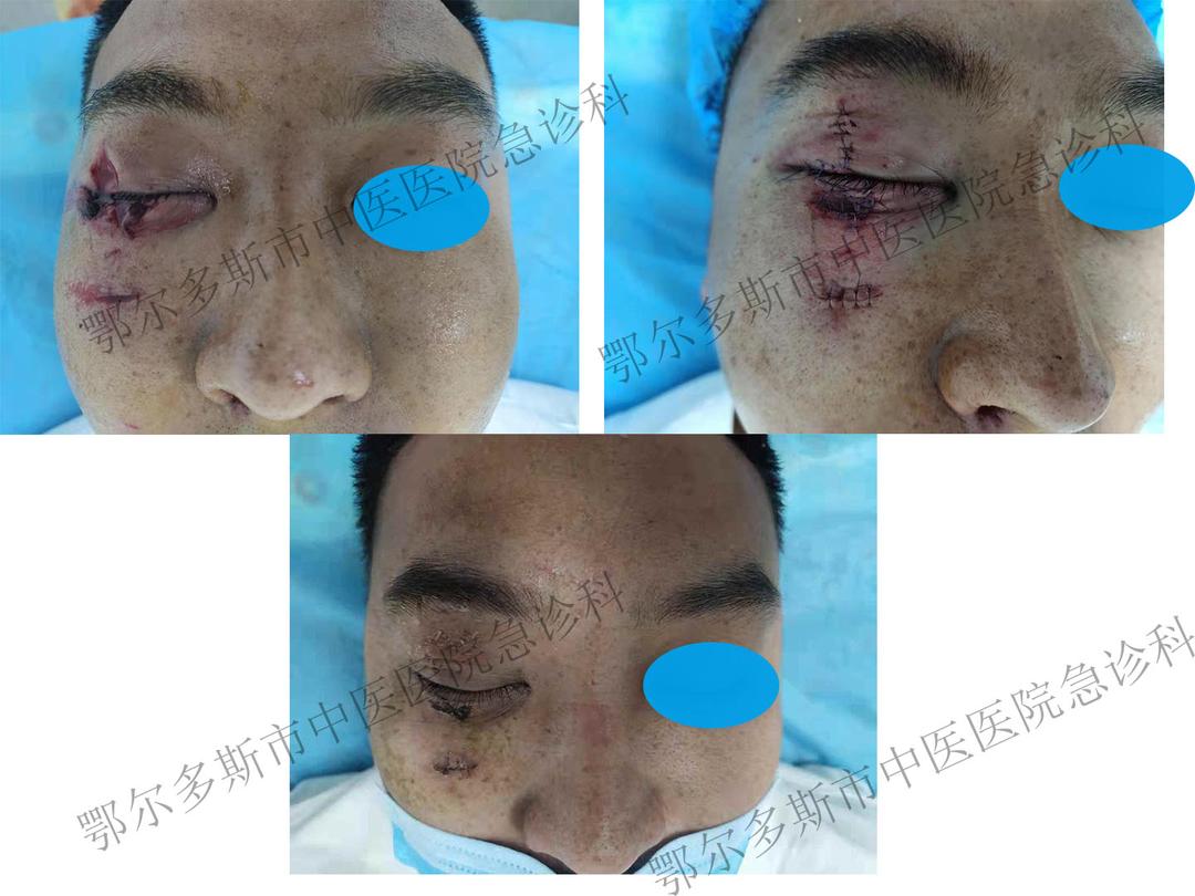 鄂尔多斯市中医医院急诊科,急诊科美容缝合后护理